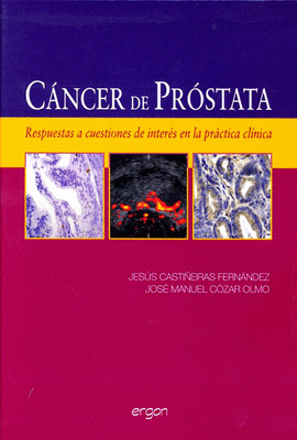 CANCER DE PROSTATA RESPUESTAS A CUESTIONES DE INTERES EN LA PRACTICA CLINICA