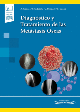 DIAGNSTICO Y TRATAMIENTO DE LAS METSTASIS SEAS