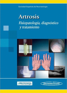 ARTROSIS FISIOPATOLOGIA DIAGNOSTICO Y TRATAMIENTO