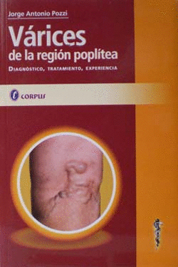 VARICES DE LA REGION POPLITEA DIAGNOSTICO, TRATAMIENTO, EXPERIENCIA
