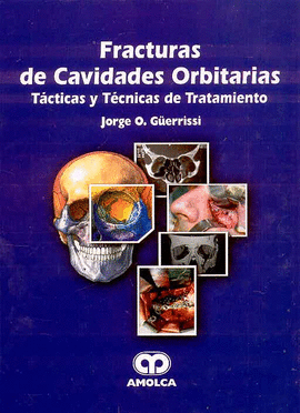 FRACTURAS DE CAVIDADES ORBITARIAS TACTICAS Y TECNICAS DE TRATAMIENTO