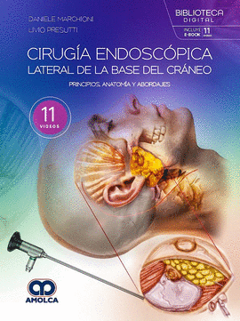 CIRUG�A ENDOSC�PICA LATERAL DE LA BASE DEL CR�NEO