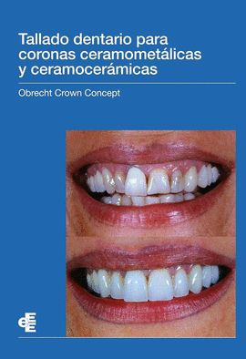 TALLADO DENTARIO PARA CORONAS CERAMOMET�LICAS Y CERAMOCER�MICAS