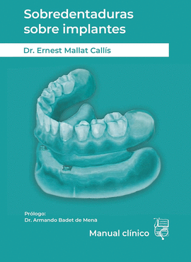 SOBREDENTADURAS SOBRE IMPLANTES : MANUAL CLNICO