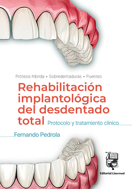 REHABILITACION IMPLANTOLOGICA DEL DESDENTADO TOTAL