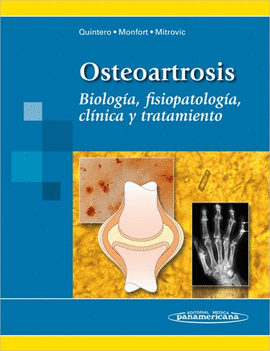 OSTEOARTROSIS BIOLOGIA FISIOPATOLOGIA CLINICA Y TRATAMIENTO