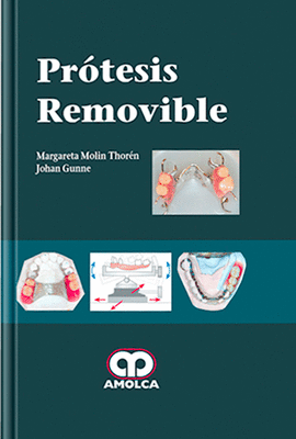 PROTESIS REMOVIBLE