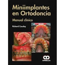 MINIIMPLANTES EN ORTODONCIA