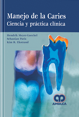 MANEJO DE LA CARIES