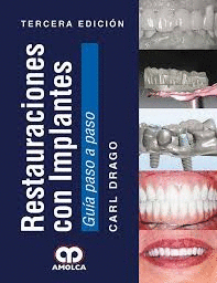 RESTAURACIONES CON IMPLANTES