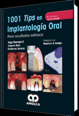 1001 TIPS EN IMPLANTOLOG�A ORAL � PARA RESULTADOS EXITOSOS