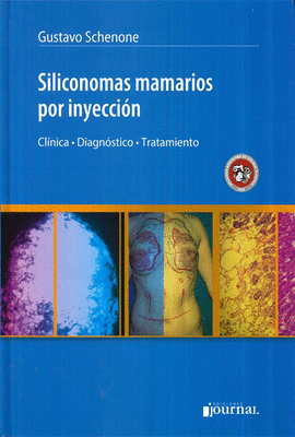 SILICONOMAS MAMARIOS POR INYECCIN